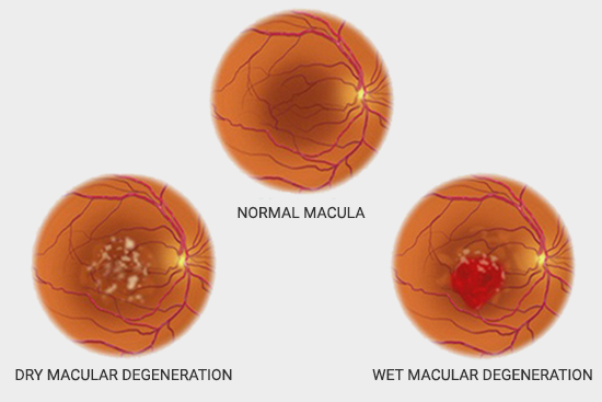 Age Related Macular Degeneration