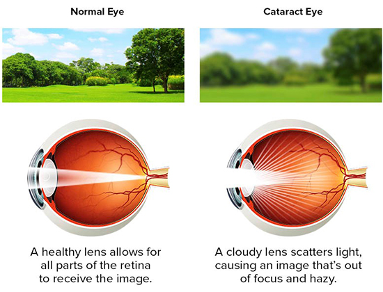 Advance Cataract Surgery