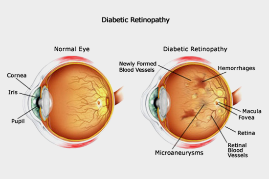 Diabetic Retinopathy