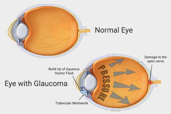 Glaucoma Services