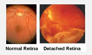 Retinal Detachment