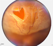 Retinal Detachment